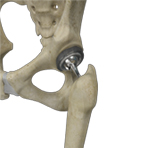 Total Hip Replacement