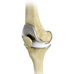 Total Knee Replacement