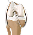 Knee Reconstruction