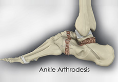 Ankle Arthrodesis