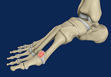 CheilectomyBig Stiff Toe (Hallux Rigidus)