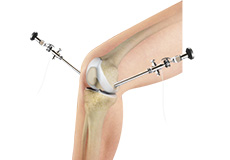 Knee Arthroscopy