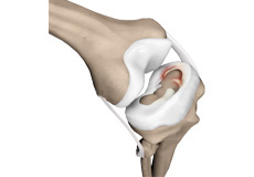 Meniscal Surgery